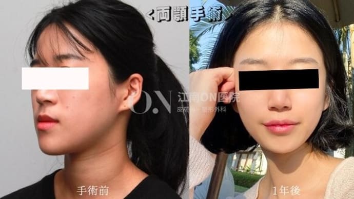 [総手術件数驚異の1万6千件オーバー]Dr.オミョンジュン 両顎手術ビフォアフセルカ