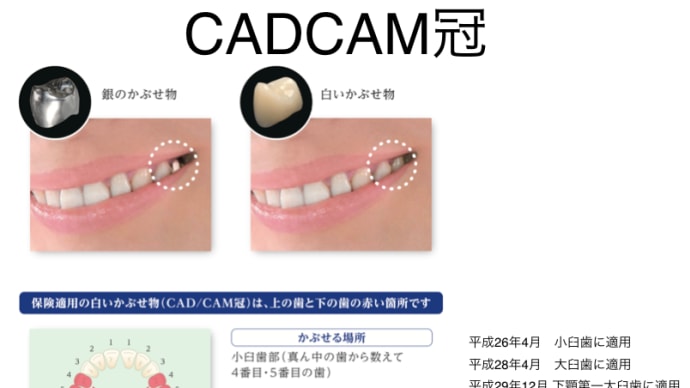 白い被せ物