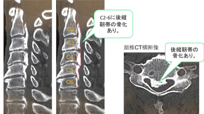 後縦靭帯骨化症 入院 手術 療養生活