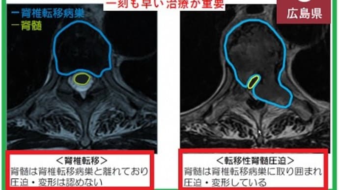 ◆転移性脊髄圧迫/がんの人の約1割で生じている(臨床腫瘍学会)/がんが骨に転移し,脊髄を圧迫することで「回復不可能な両足まひ」になる可能性(広島がんネット)