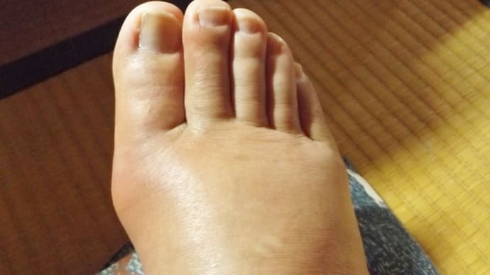 報告 痛風 歩けません