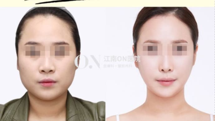 【骨トップ】女性らしい卵形フェイスに完成させるには、骨トップの輪郭手術!