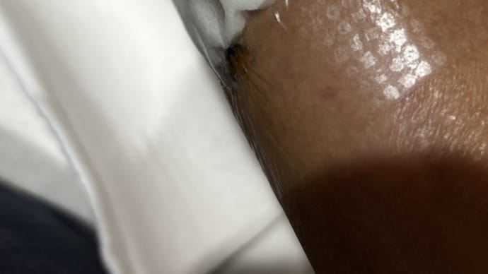 手首骨折 手術後6日 1/22
