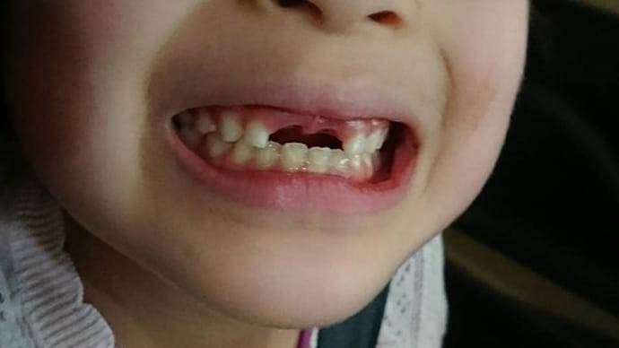 孫娘、乳歯の上前歯が抜ける　（2021年5月）