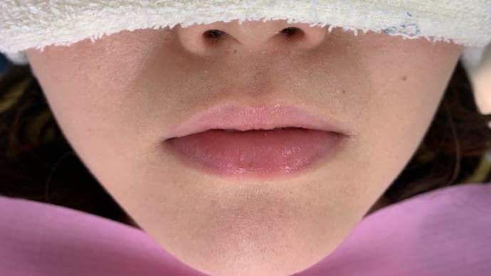 下顎の骨に埋まった親知らずの抜歯、腫れません痛がらせません。
