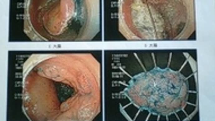 ケトン体もガンの栄養になるという、悲しい情報を得る。ガクッ。。