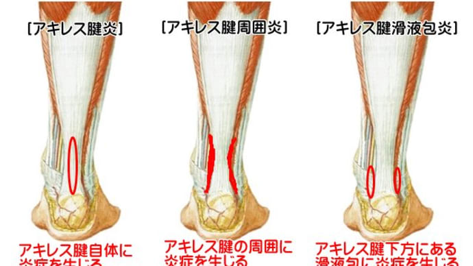 まさかのアキレス腱痛に