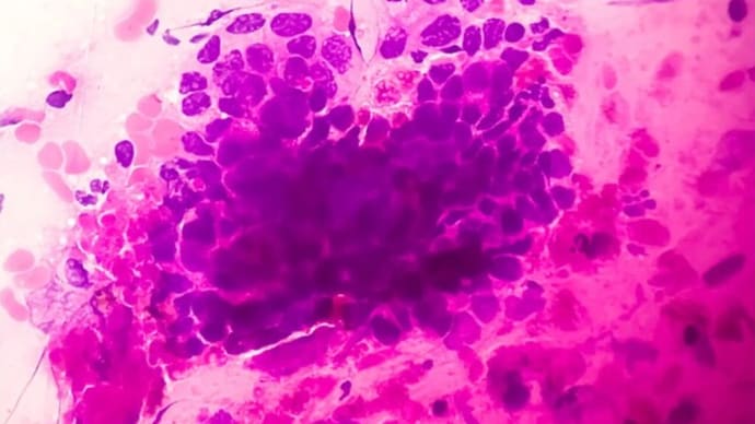 HPVの背後にいる子宮頸がんの真犯人とは(下)