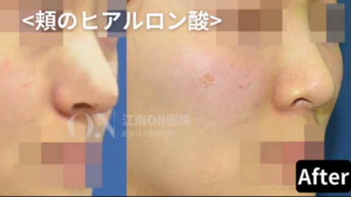 【江南ON医院】のっぺりした印象は、頬ヒアルロン酸で解決!