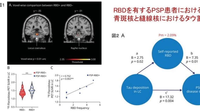 進行性核上性麻痺におけるレム睡眠行動異常症の意義 ―サブタイプや予後予測に有用かもしれない―