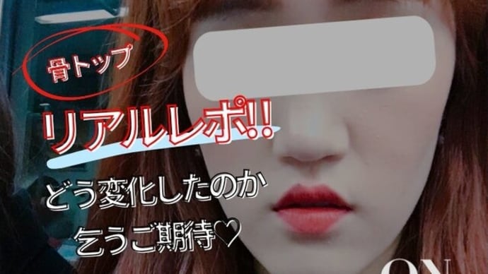 【骨トップ】 ひどい受け口の方リアルレポ♡セルカ写真付き
