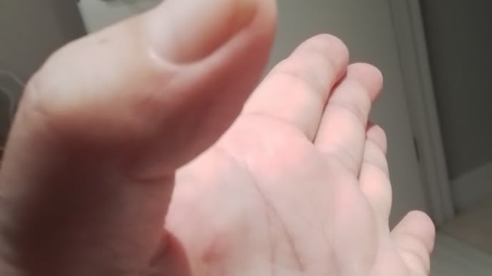 親指が反れないのは、長母指伸筋腱皮下断裂が原因