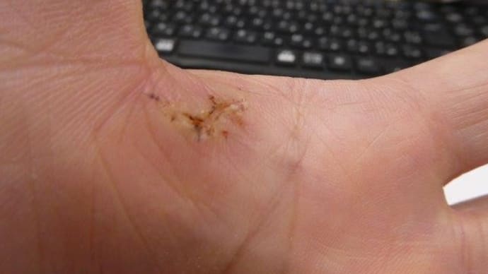 抜糸 だぜ ! バシッと… 行かなかったあああ