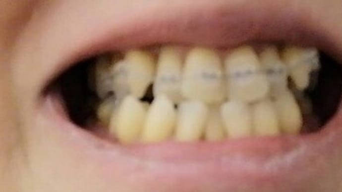 今更歯科矯正なんだけどさ