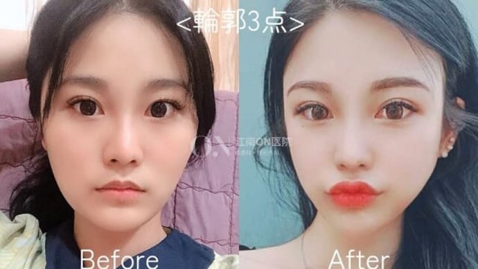 Dr.オミョンジュン 輪郭3点(頬骨縮小+オトガイ骨切り)手術症例写真