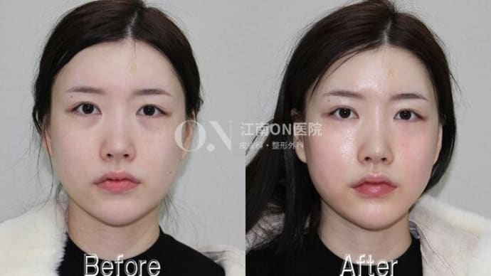 美容先進国韓国でも一番アツい施術🔥チタニウムリフト症例写真です🥰