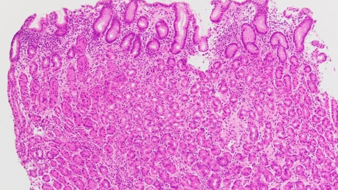 Focally enhanced gastritis, discontinuous and disproportionate inflammation
