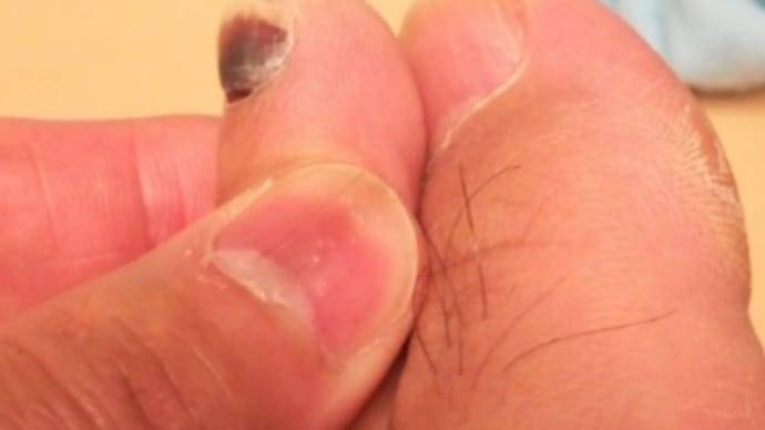 たまにやってしまう山歩きでの爪を死なすこと