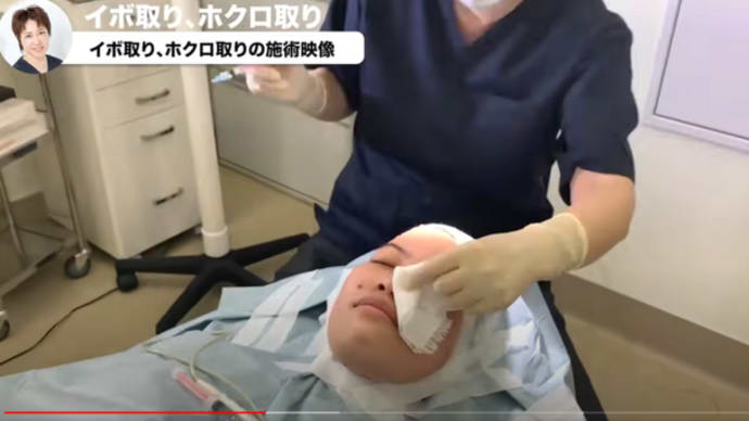 【大公開】巨大ほくろをブっこ抜く!!この神業に注目!🌺女医です👀💕 自力で二重にした方法