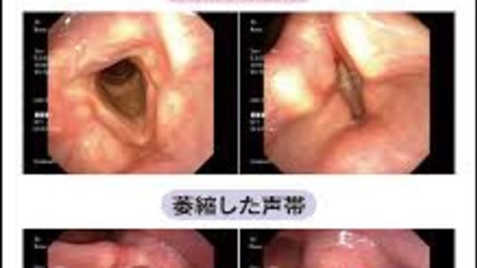 Gene mutation in 40 to 80% of cells in the elderly esophagus/高齢者の食道で4~8割の細胞で遺伝子変異