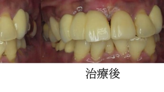 保険 CAD/CAM冠 前歯 治療症例
