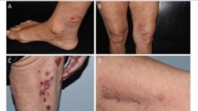 小水疱性皮膚反応：COVID-19 mRNAワクチンによる障害報告のレビュー