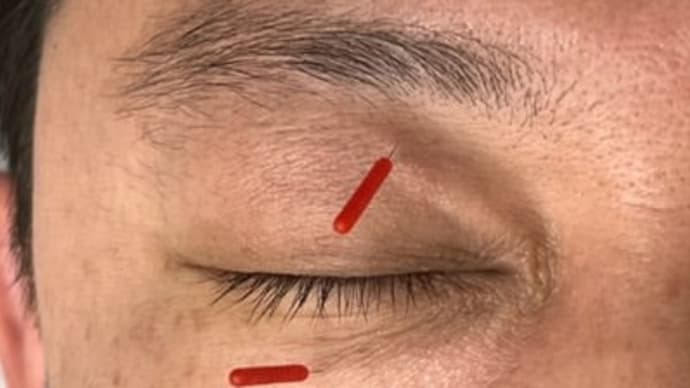 飛蚊症:眼窩内刺鍼