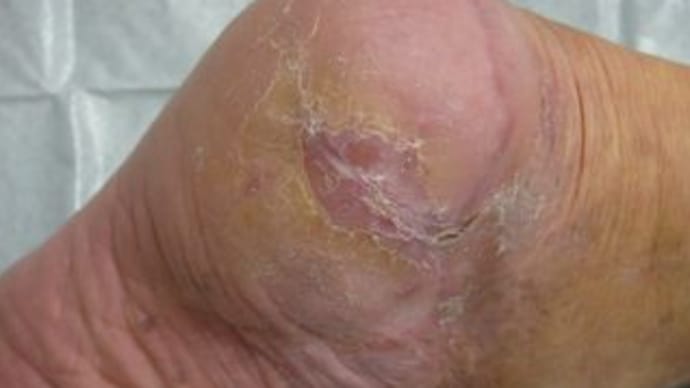 踵部皮膚壊死の湿潤療法６（最終報告）