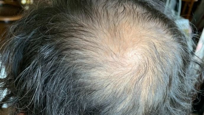 男性型脱毛症（AGA）の治療