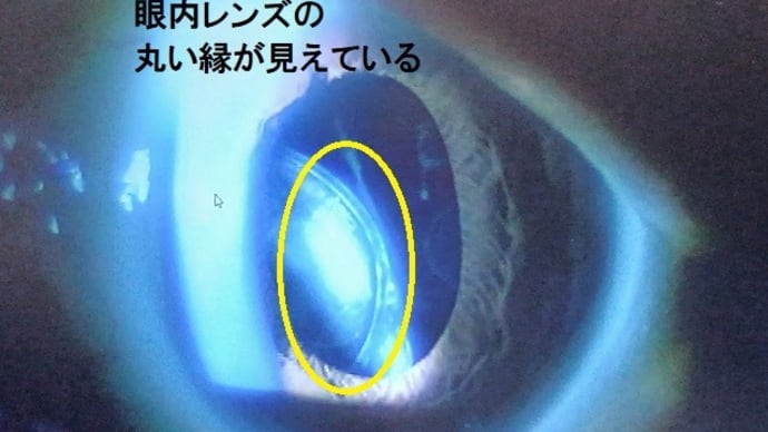妻の眼の手術が終わった
