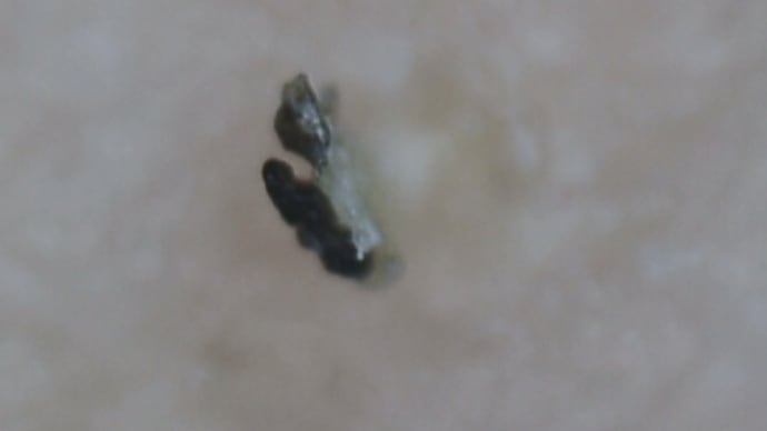 入口ページ〉傷口等に現れる漆黒異物