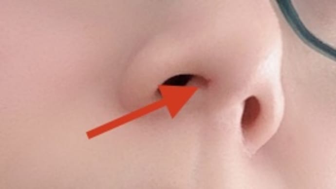 鼻の穴の入り口が切れる