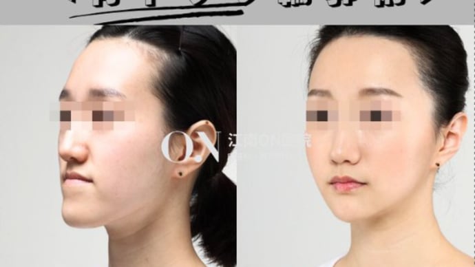 【江南ON医院】骨トップの手術で理想の卵形フェイスに完成！
