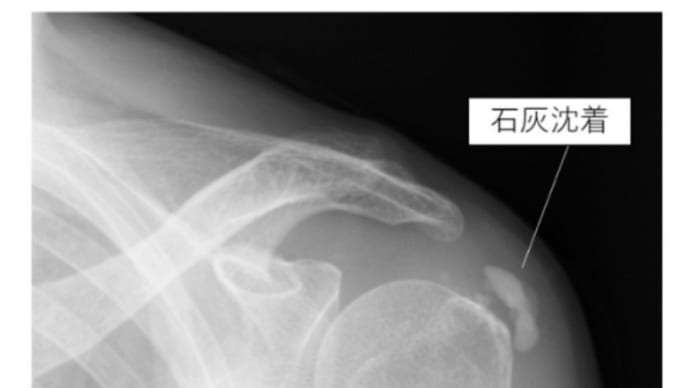 石灰沈着性腱板炎になりました。