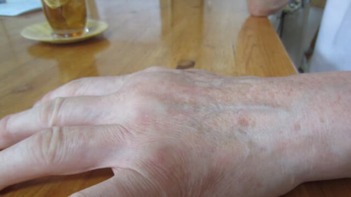 手の甲の腫れと痛み、肘~手首間の小指側が痛い