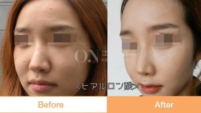 専門医歴20年のノウハウ💡ヒアルロン酸注入症例写真