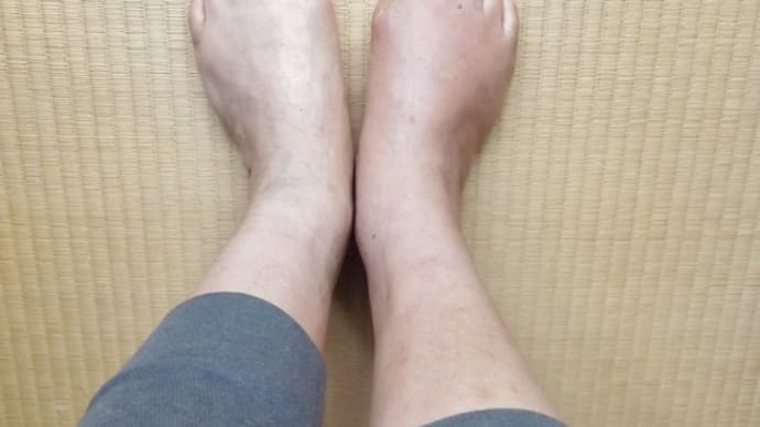 報告 痛風