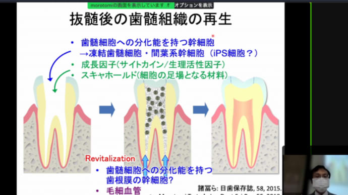 なぜ歯の根の治療は上手くいかないのか?