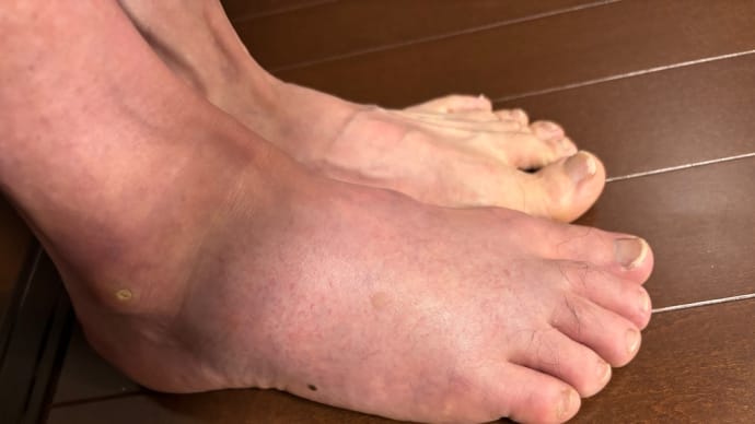 複雑骨折しました。