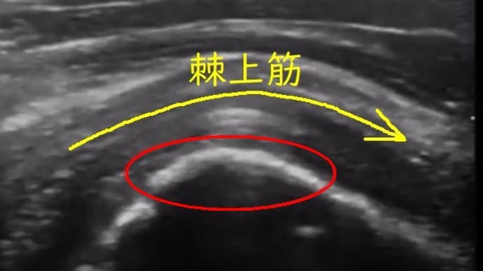 左肩の腱板断裂、その後