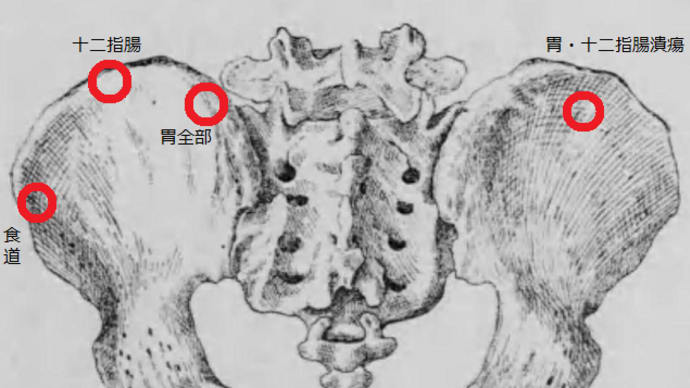 胃腸潰瘍の診断法