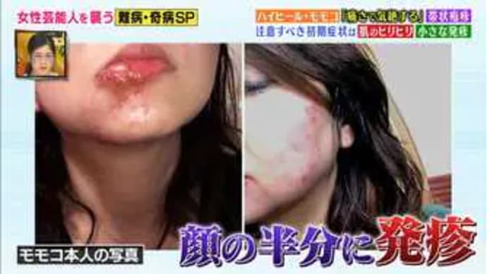 #037【激痛!】「帯状疱疹」とは?(前編) モモコを突然襲った病「帯状疱疹」について知ってほしいことを経験者として語ります。
