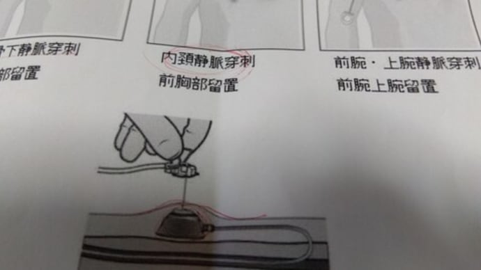 埋込型中心静脈カテーテルポート留置術