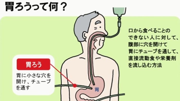 『胃ろうの是非』『老人力』『老人力発揮』