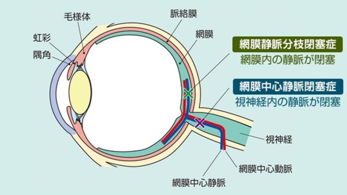 ワクチン接種後、失明&視力低下した方にイベルメクチン