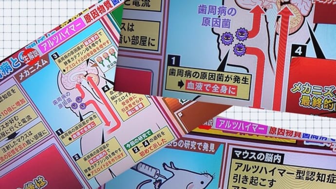歯周病からアルツハイマー…