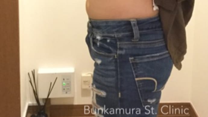 お腹に2回の注射で 下腹マイナス3cm 体重マイナス2kg 20代女性 もう効果が出てきました!