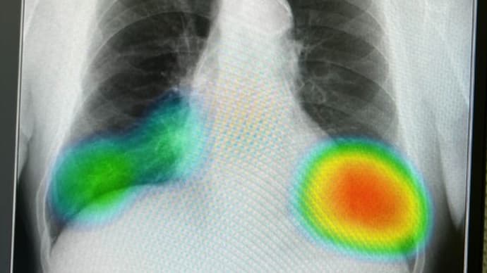 胸部レントゲン写真のAI診断装置