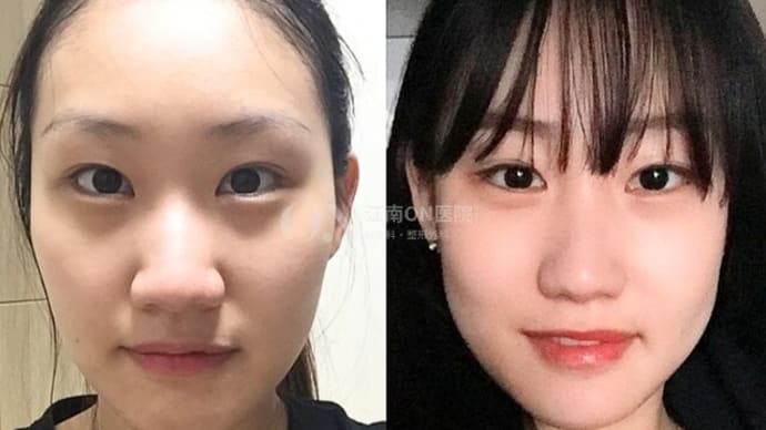 Dr.オミョンジュン 輪郭2点(小顔形成術)手術症例写真