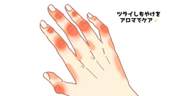 しもやけのアロマケア